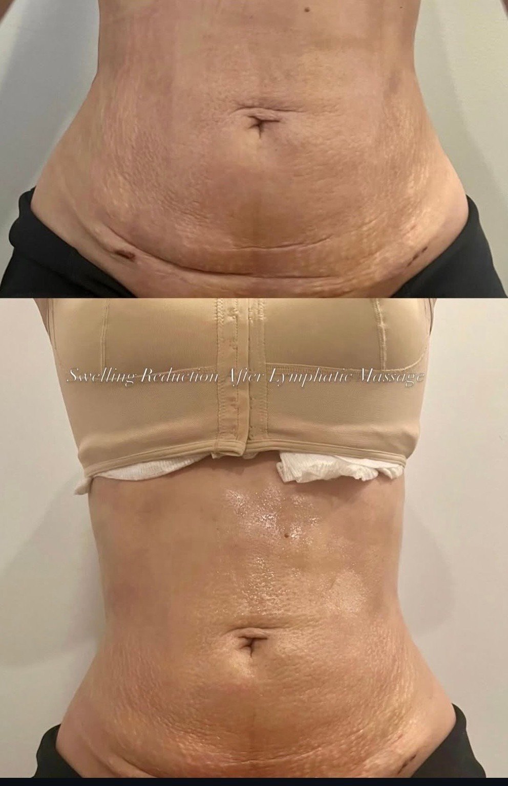 Post-op massage before and after at Divina Skin & Body in Sarasota