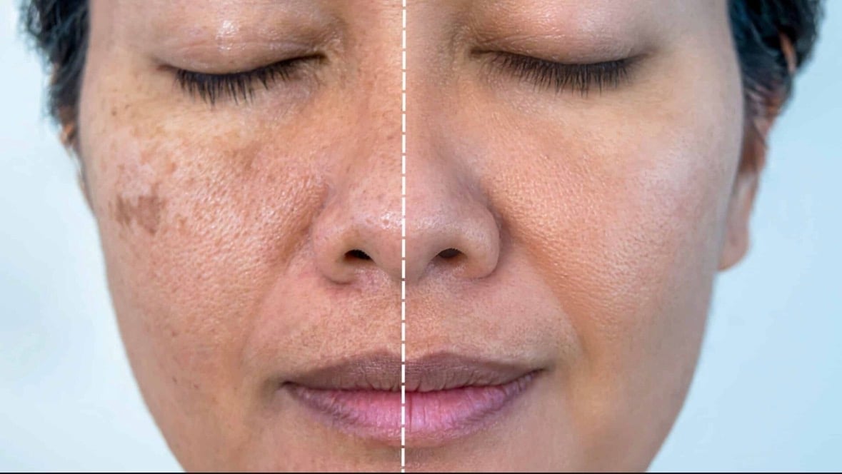 Before and after face comparison showing skin treatment results on left and right sides of face with eyes closed